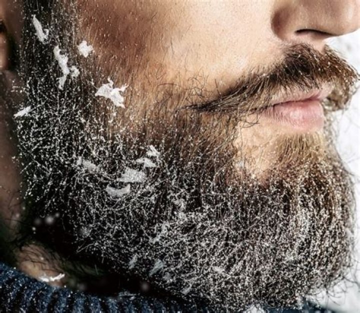 beard dandruff