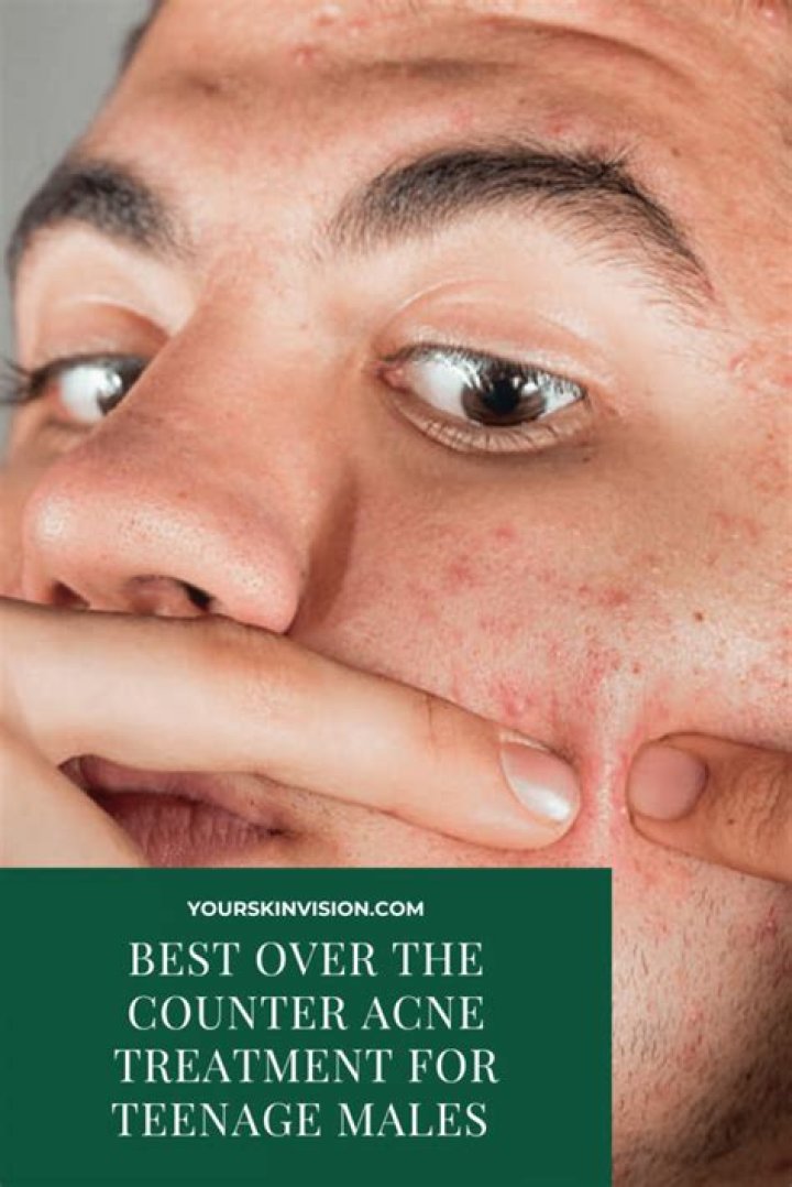 best over the counter acne treatment