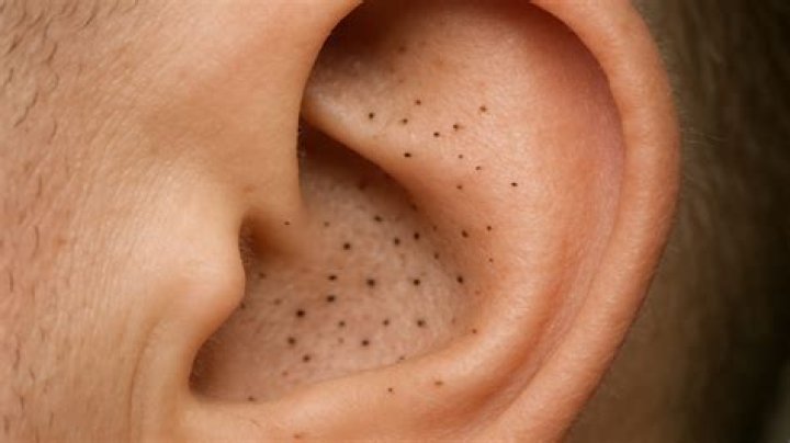 Blackheads In Ear