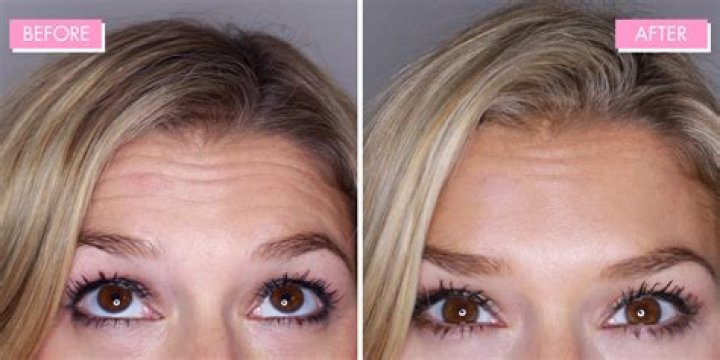 botox before after
