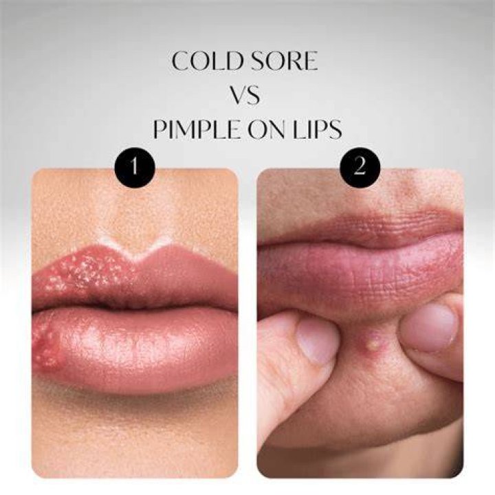 bump on lip not cold sore