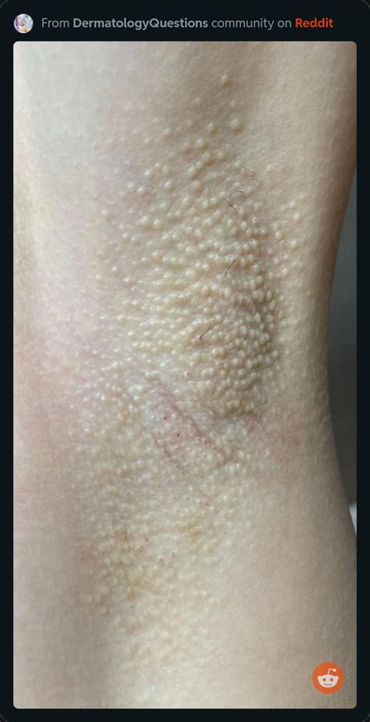 bumps under armpit