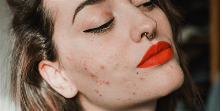 cheek acne causes