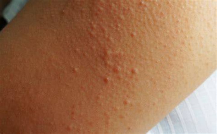 chicken skin on arms