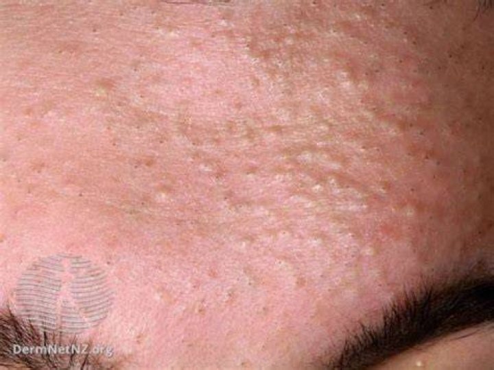 comdeonal acne