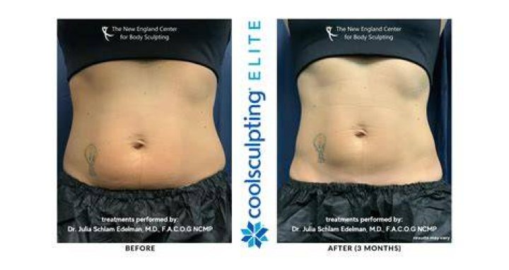 Coolsculpting: What’s it for and is it worth the money? Coolsculpting: What’s it for and is it worth the money?