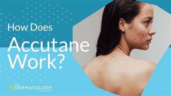 does accutane work