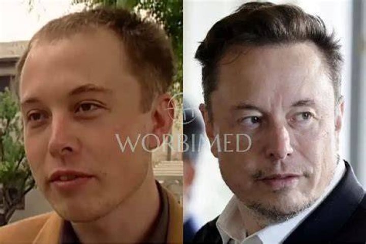 Elon Musk Hair Transplant method