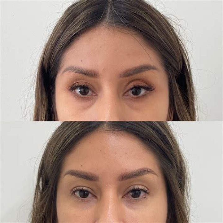 eye filler before and after