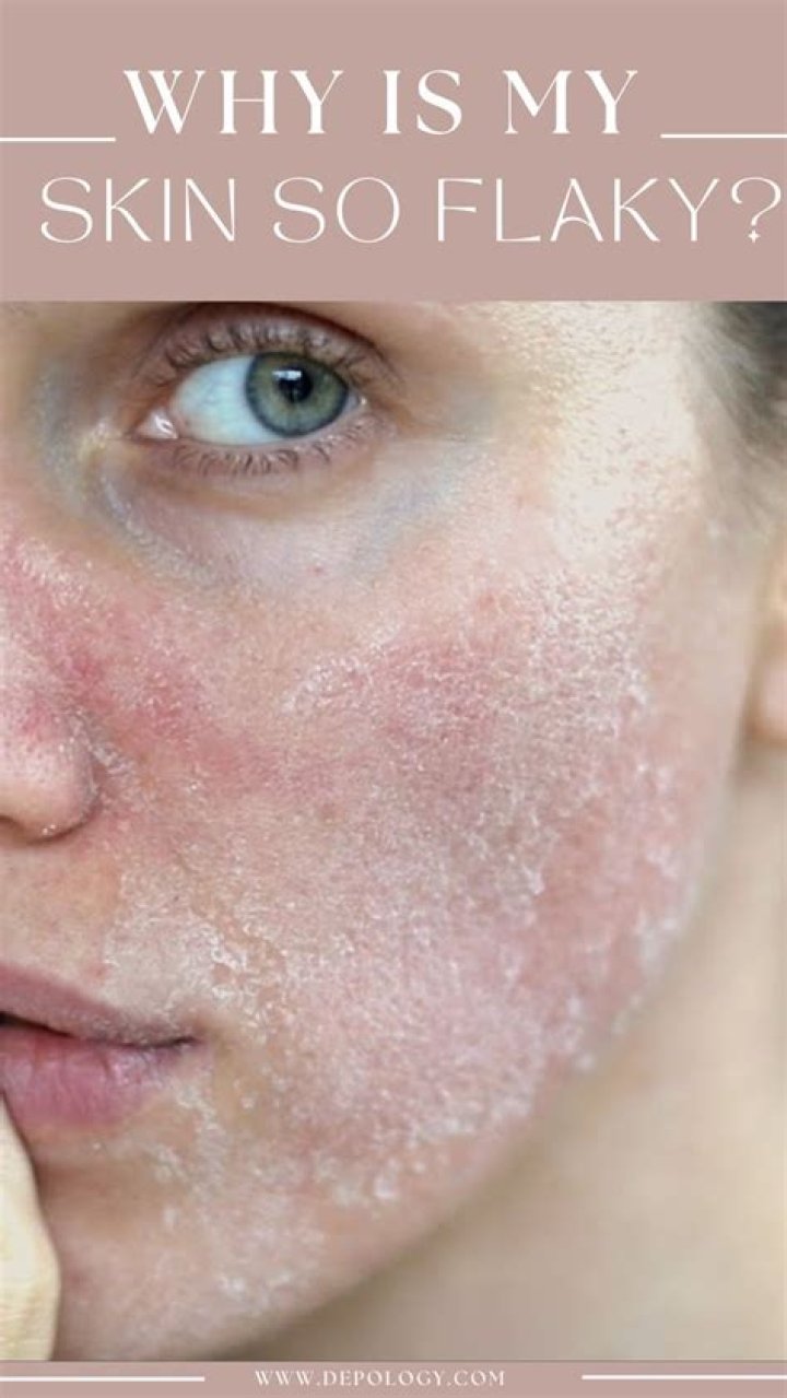 flaky skin on face