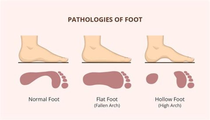 Flat Feet