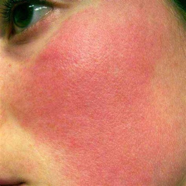 flushed skin