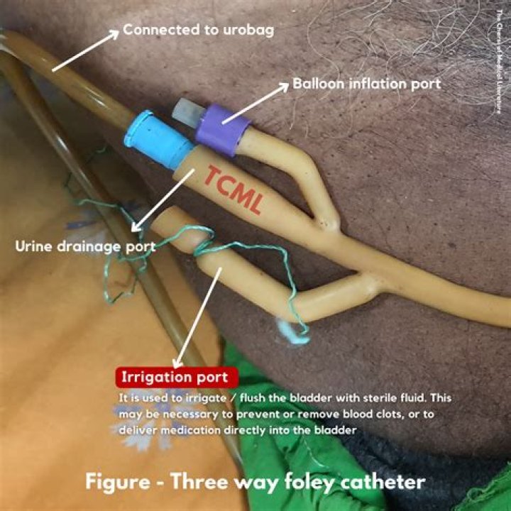 foley catheter irrigation