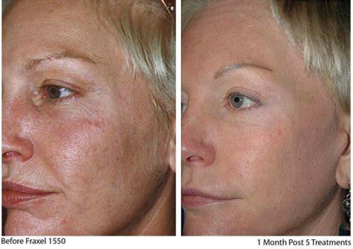 fraxel laser treatment