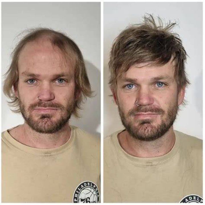 Hair Replacement System