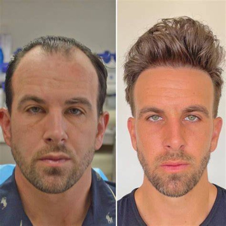 Hair Replacement