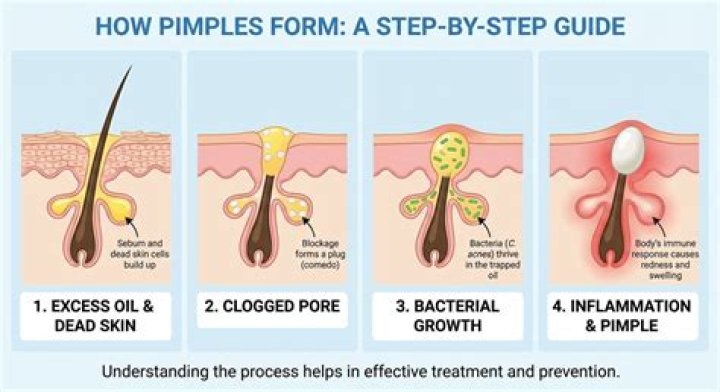 how do pimples form