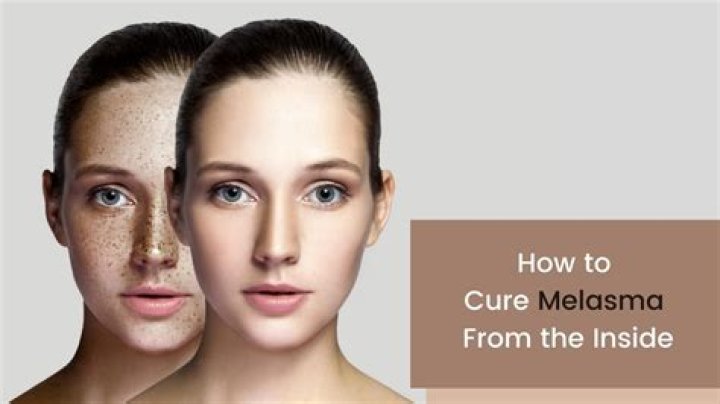 how to cure melasma from the inside