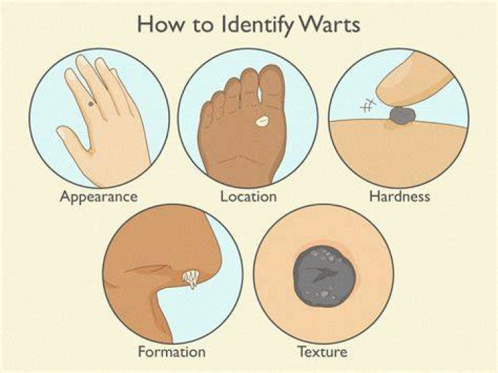 how to identify a wart