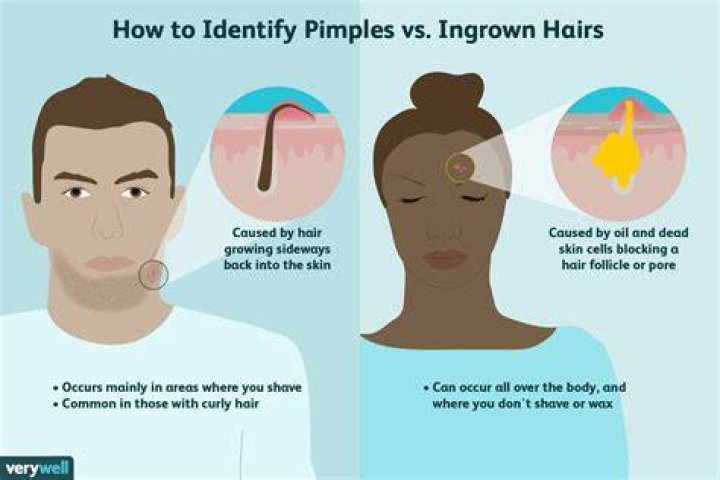 ingrown pimple
