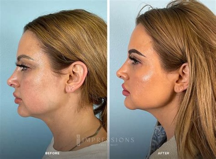 jawline filler cost