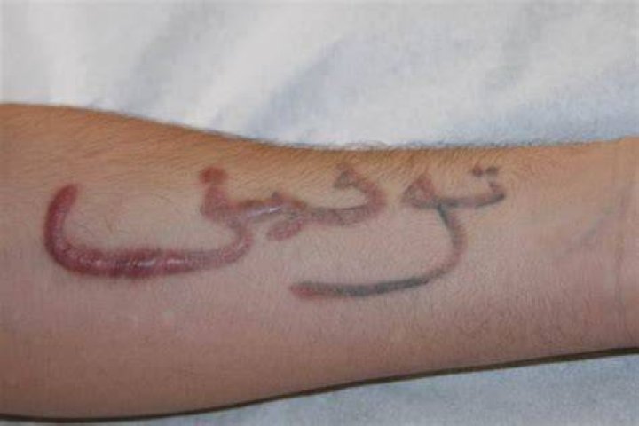 keloid scar tattoo