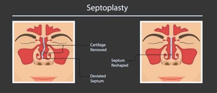 Septum Surgery