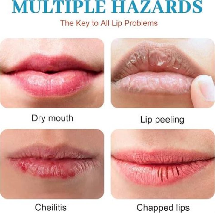 severe chapped lips