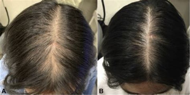 spironolactone hair loss