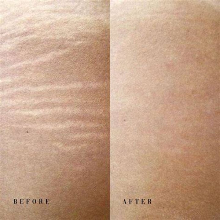 Stretch mark tattoos