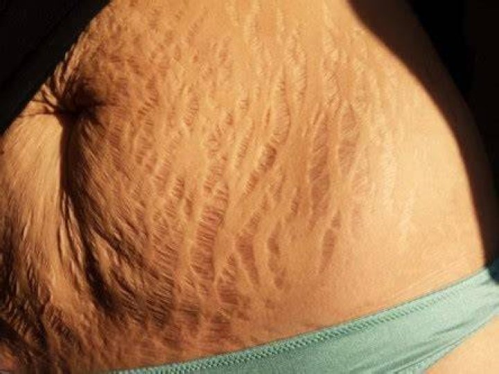 Stretch marks after Pregnancy