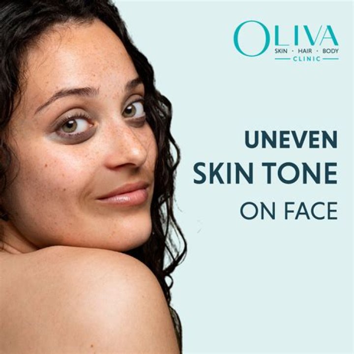 uneven skin tone on face