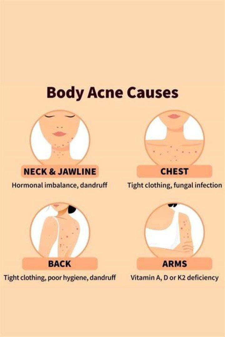 what causes chest acne