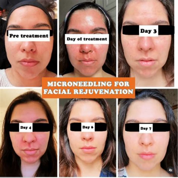 what does microneedling do
