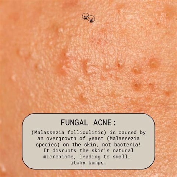 what is fungal acne