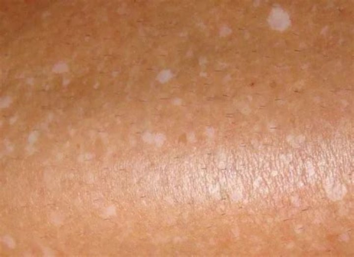 white spots on legs